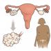 Sindromul ovarului polichistic: simptome, diagnostic, tratament Sindromul ovarului polichistic congenital