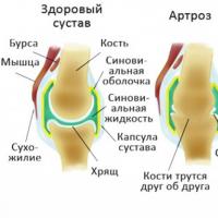 რატომ მტკივა მუხლი, თუ დიდხანს ვიჯექი?