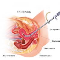 How long does discharge last after hysteroscopy?