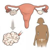 Синдром на поликистозни яйчници: симптоми, диагноза, лечение Вроден синдром на поликистозни яйчници
